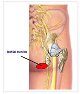 Corticosteroid injection hip