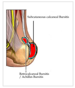 achilles heel bursitis treatment