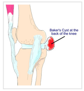 Bakers_cyst