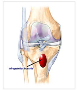 Infrapatellar_bursitis