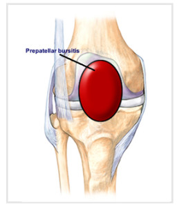 Prepatellar_bursitis