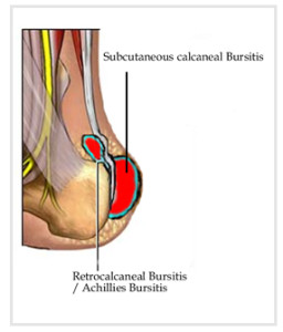 Retrocalcaneal_bursitis