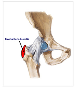 Trochanteric_bursitis