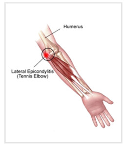 lateral_epicondylitis