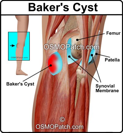 cyst bakers osmo arthritis swelling swollen meniscus rheumatoid bursa headache medial bursitis cupping acupressure painful acupuncture