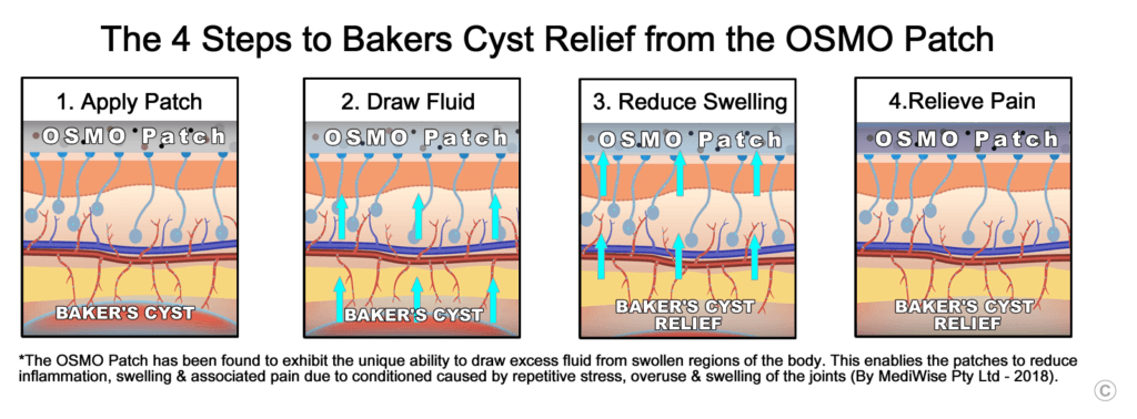 Baker's Cyst Relief - OSMO Patch