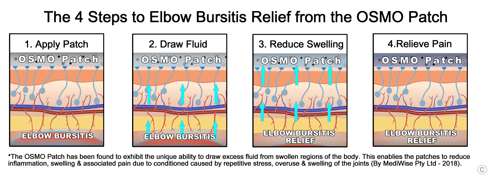 Elbow Bursitis Treatment and Natural Remedies OSMO Patch US