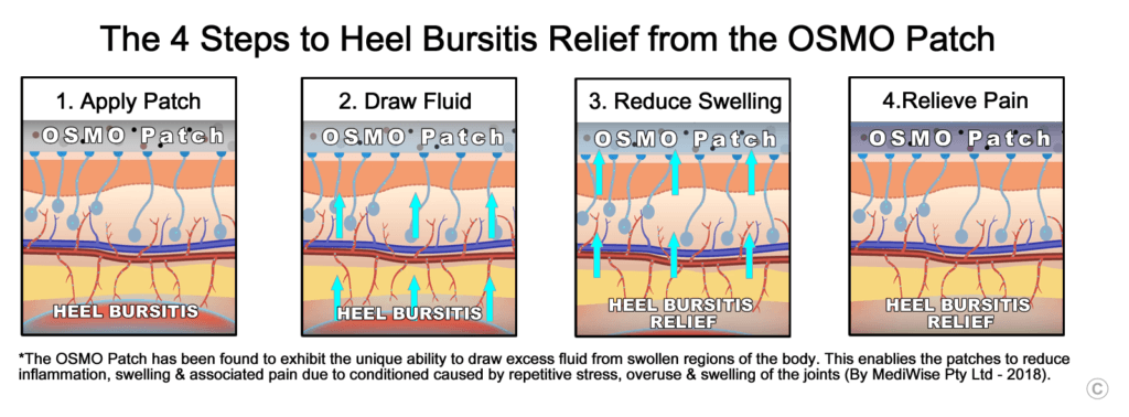 Heel Bursitis Relief - OSMO Patch