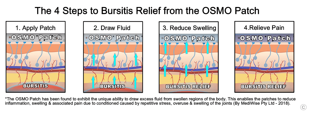 Bursitis Relief stages - OSMO Patch