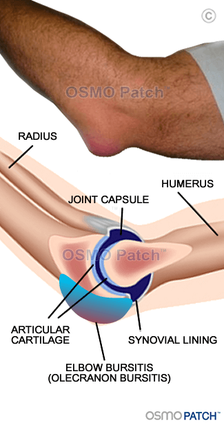 Elbow Bursitis - OSMO Patch - US