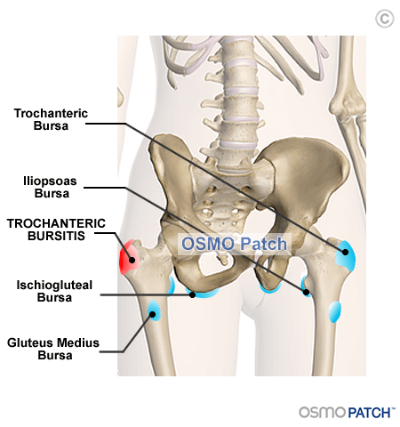 Hip Bursitis - OSMO Patch - US