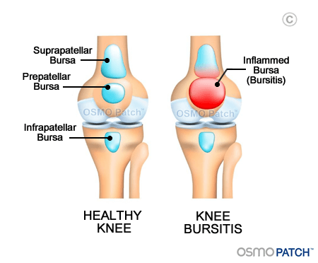 Knee Bursitis before & after - OSMO Patch - US