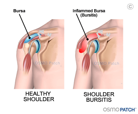 Shoulder Bursitis before & after - OSMO Patch - US