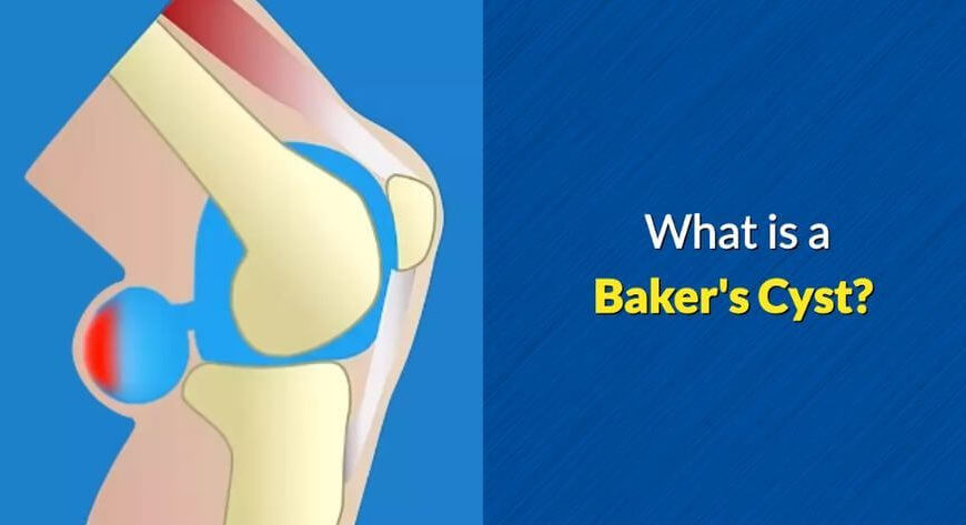 What is a Baker's Cyst by OSMO Patch