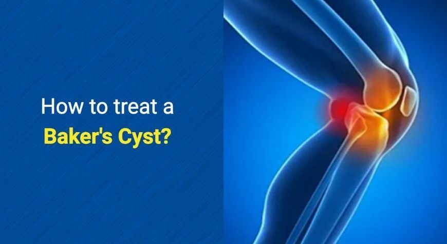 How to treat a Baker's Cyst by OSMO Patch. 