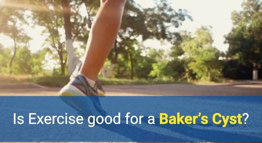 Is exercise good for a Baker's Cyst by OSMO Patch