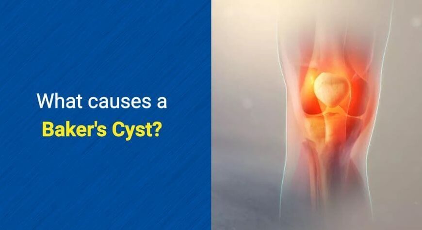 What causes a Baker's Cyst by OSMO Patch